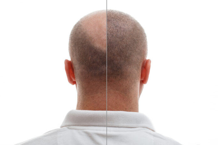 Hair Loss